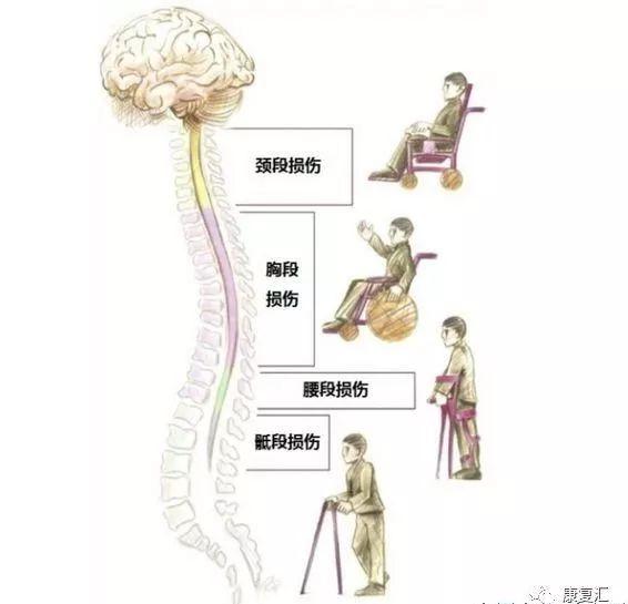 脊髓损伤最新突破，重塑康复的希望之光